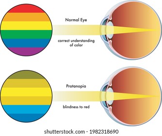 Medical illustration shows the different perception of colors between a normal eye and one affected by protanopia.