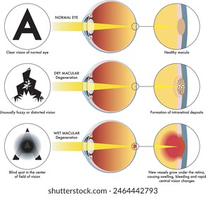 Die medizinische Illustration zeigt ein gesundes Auge und Symptome, die ein von trockener und feuchter Makulopathie betroffenes Auge betreffen, mit Anmerkungen.