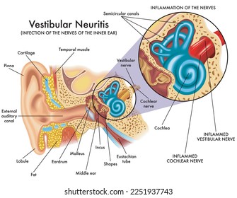 Medical illustration shows the infection and inflammation of the nerves of the inner ear, called vestibular neuritis, with annotations.