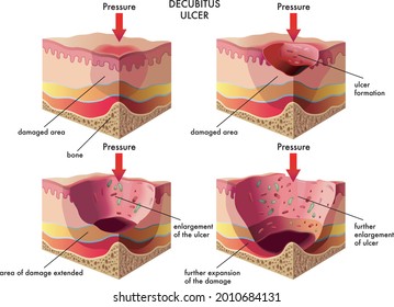 Medical Illustration Shows The Progression Of A Decubitus Ulcer.