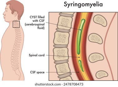 Medical illustration shows the symptoms of Syringomyelia, a pathology that affects the spine.