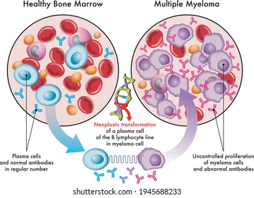 Medical Illustration Shows The Transformation Of Plasma Cells In Healthy Bone Marrow Into Myeloma Cells In Multiple Myeloma, Due To DNA Damage.