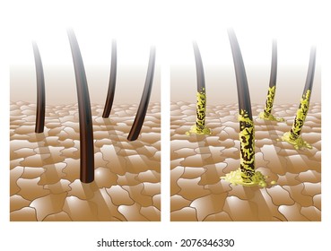 Medical  illustration of skin and hair, normal and greasy or with excessive sebum secretion.