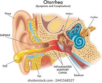 Medizinische Illustration einiger Symptome und Komplikationen der Otorrhö, eine Pathologie, die das Ohr betrifft, mit Anmerkungen.