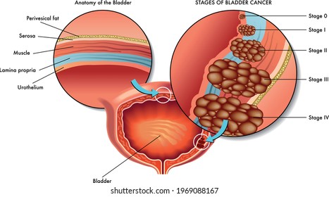 Bladder Cancer Hd Stock Images Shutterstock