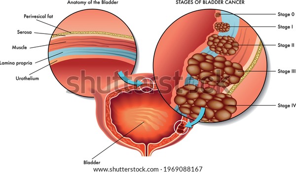 Medical illustration of stages of the\
bladder cancer, with\
annotations.