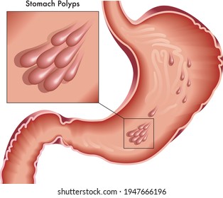 Medical illustration of stomach with polyps.