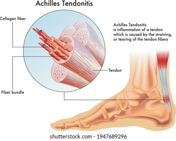 Medical illustration of the symptoms of Achilles tendonitis or inflammation of a Achilles tendon.