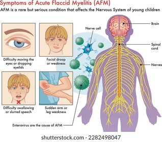 Ilustración médica de los síntomas de la mielitis fláccida aguda (AFM), con anotaciones.