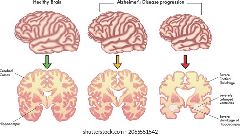 Medical illustration of the symptoms of Alzheimer's disease progression.