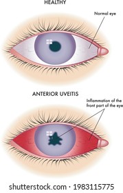 Medical illustration of the symptoms of anterior uveitis.