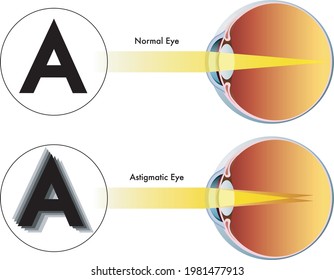 Medical illustration of the symptoms of astigmatism.