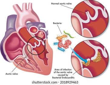 Medical Illustration Of The Symptoms Of Bacterial Endocarditis.