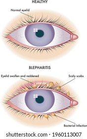 Medical illustration of the symptoms of blepharitis.