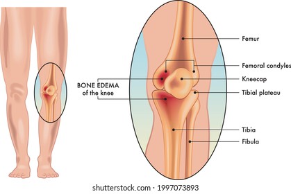 Ilustración médica de los síntomas de un edema óseo en una rodilla.