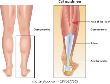 Medical illustration of the symptoms of calf muscle tear, with annotations on white background.