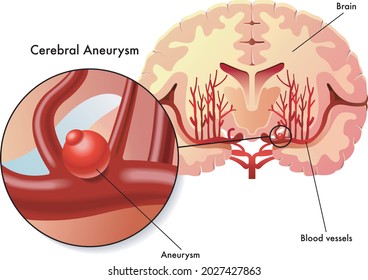Medical illustration of the symptoms of cerebral aneurysm.