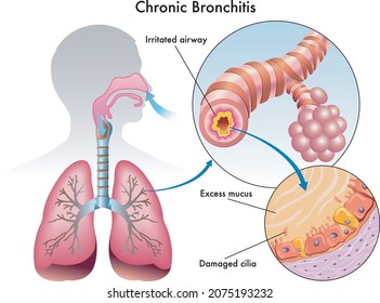 Medical illustration of symptoms of chronic bronchitis.