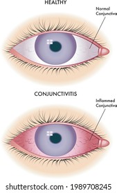 13 Conjunctival Sac Images, Stock Photos & Vectors | Shutterstock