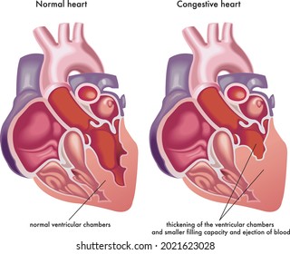 Medical Illustration Symptoms Consequences Congestive Heart Stock ...