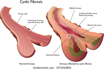 Medical illustration of symptoms of cystic fibrosis, with annotations, on white background.
