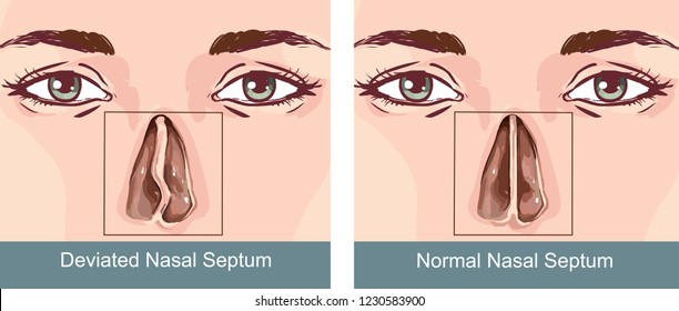 ilustración médica de los síntomas de un septum nasal desviado