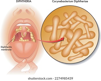 Ilustración médica de los síntomas de la difteria, con anotaciones.