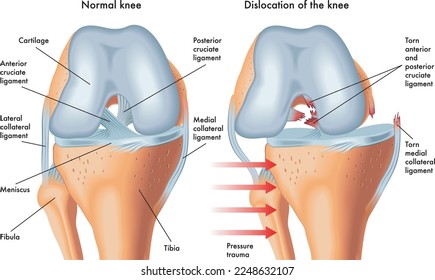 Medical illustration of symptoms of dislocated knee, with annotations.