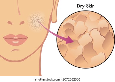 Medical illustration of the symptoms of dry skin. 