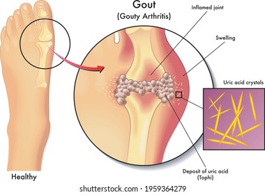 Medical illustration of the symptoms of gout.