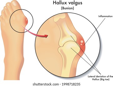 Medical illustration of the symptoms of hallo valgus.