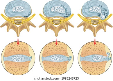 Medical illustration of the symptoms of herniated disc.