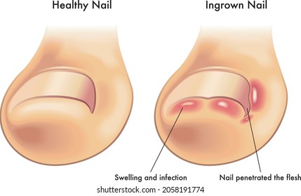 Medical illustration of the symptoms of ingrown nail.