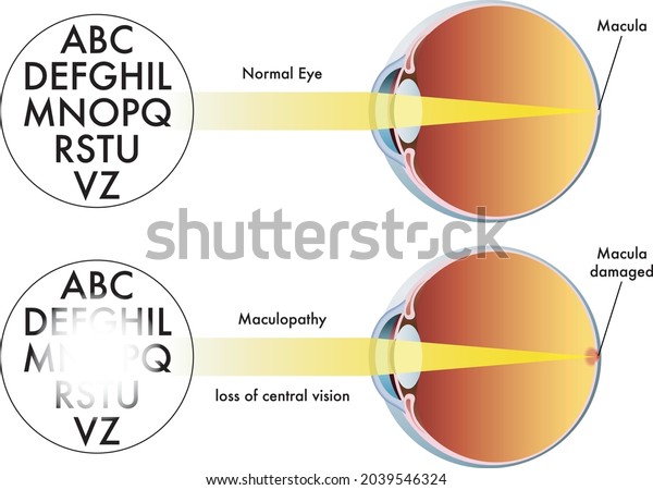 Medical Illustration Symptoms Maculopathy Stock Vector (Royalty Free ...