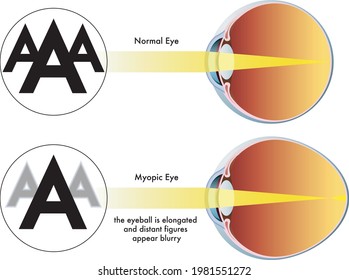 Medical Illustration Of The Symptoms Of Myopia.