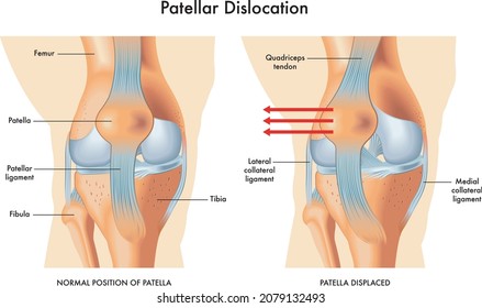 Medizinische Veranschaulichung von Symptomen einer patellaren Verlagerung, mit Anmerkungen.