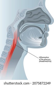 Medical illustration of symptoms of pharyngitis. 