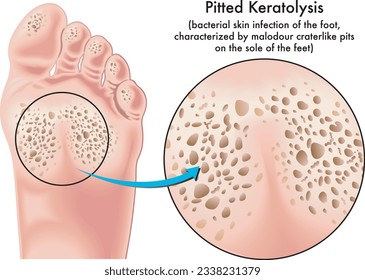 Medical illustration of symptoms of pitted keratolysis, a bacterial skin infection of the foot.