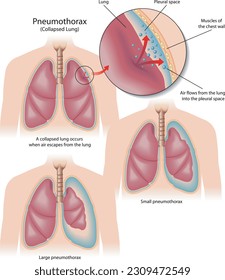 Medizinische Veranschaulichung der Symptome von Pneumothorax, mit Anmerkungen.