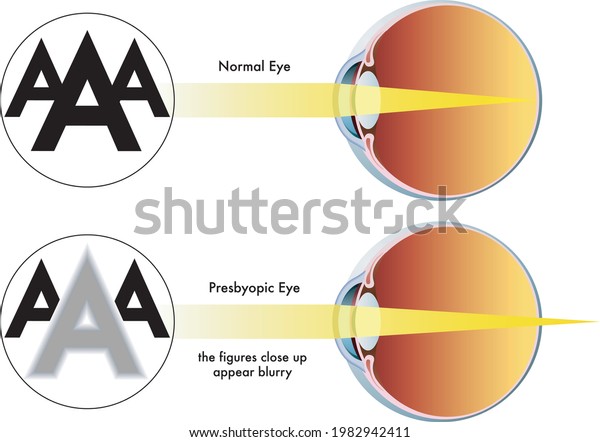 Medical\
illustration of the symptoms of\
presbyopia.