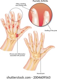 Medical illustration of the symptoms of psoriatic arthritis.