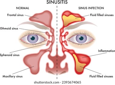 Medical  illustration of symptoms of Sinusitis.