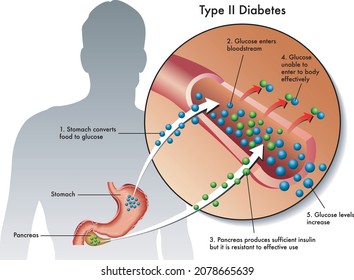 Medical illustration of the symptoms of type 2 diabetes.