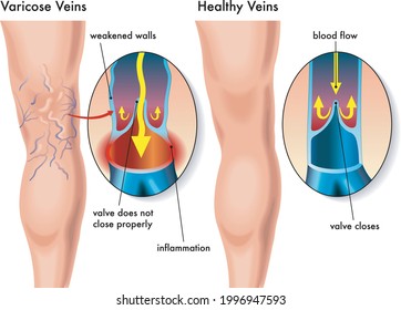 Medical illustration of the symptoms of the varicose veins.