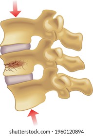 Medical illustration of the symptoms of vertebral compression fracture.