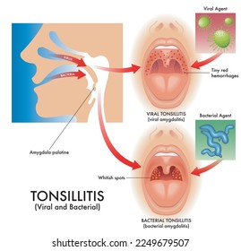 Medical illustration of the symptoms of viral and bacterial tonsillitis, also called viral amygdalitis and bacterial amygdalitis, with the pathogens that cause the infection.