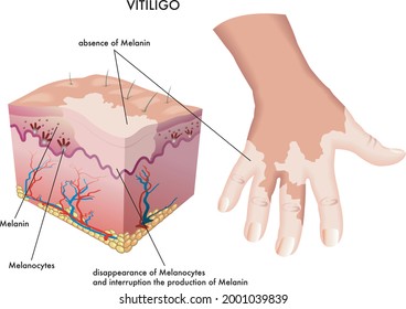 Medical Illustration of the symptoms of vitiligo.