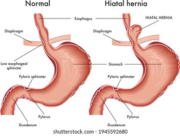 Medical illustration that compares a normal stomach and one with a hiatal hernia.