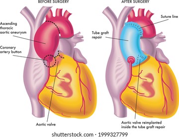Medical illustration of a thoracic aortic aneurysm surgery.