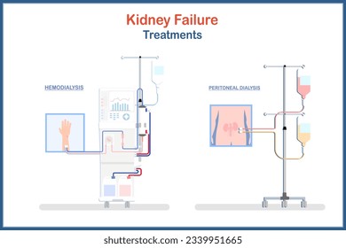 ilustración médica Tratamiento de la insuficiencia renal. Hemodiálisis y diálisis peritoneal. Ilustraciones vectoriales. Conceptos médicos y de atención de la salud.